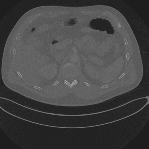 Chest multitrauma - aortic injury (Radiopaedia 34708-36147 Axial bone window 311).png