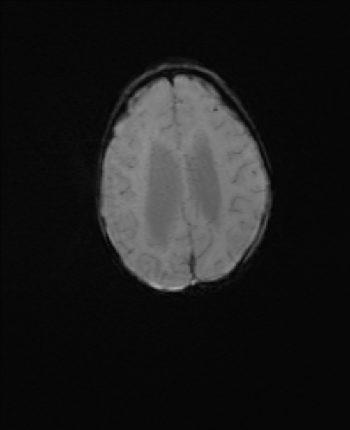 Chiari III malformation with occipital encephalocele (Radiopaedia 79446-92559 Axial SWI 47).jpg