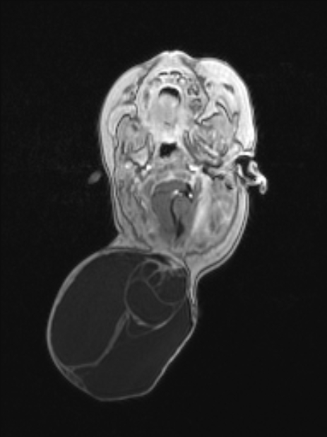 Chiari III malformation with occipital encephalocele (Radiopaedia 79446-92559 Axial T1 C+ mpr 31).jpg