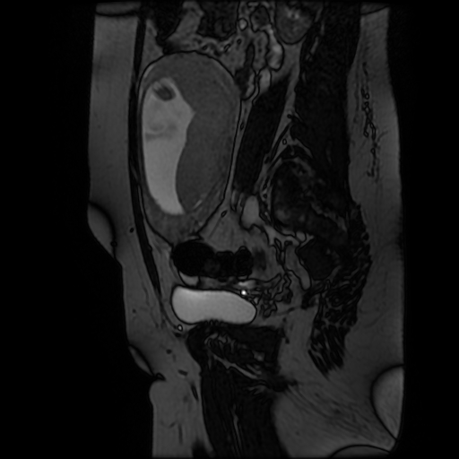 Chiari II malformation - fetal MRI (Radiopaedia 68099-77581 Sagittal Fiesta 40).jpg