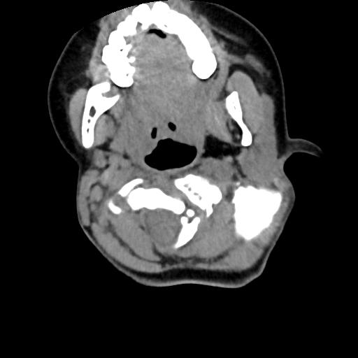 Chiari I with syrinx and skull base anomalies (Radiopaedia 89444-106412 Axial non-contrast 55).jpg