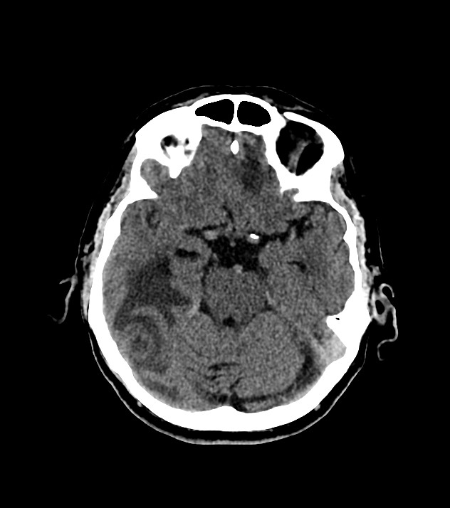Cholangiocarcinoma with cerebral metastases (Radiopaedia 83519-98628 Axial non-contrast 27).jpg