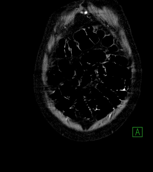 Cholangiocarcinoma with cerebral metastases (Radiopaedia 83519-98629 E 11).jpg