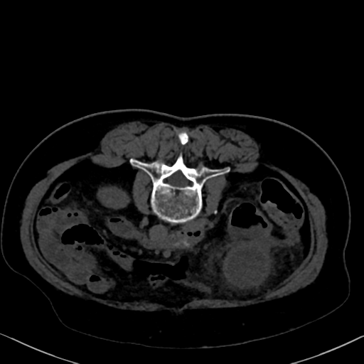 File:Cholecystitis - obstructive choledocholitiasis (CT intravenous cholangiography) (Radiopaedia 43966-47479 Axial 58).png