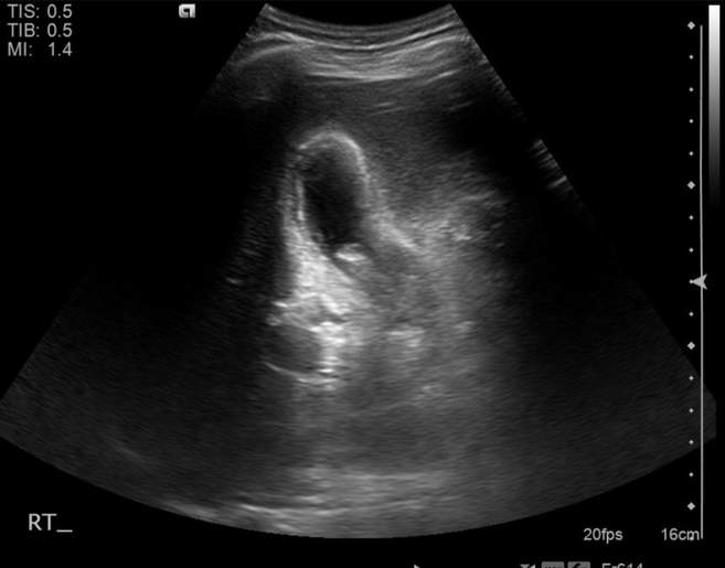 File:Cholecystitis - perforated gallbladder (Radiopaedia 57038-63913 A 29).jpg