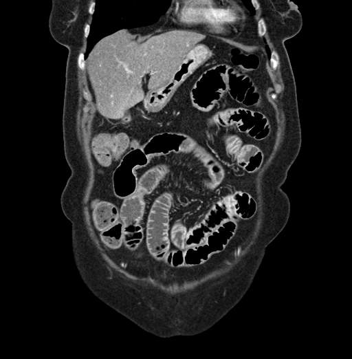 File:Cholecystoduodenal fistula due to calculous cholecystitis with gallstone migration (Radiopaedia 86875-103077 B 12).jpg