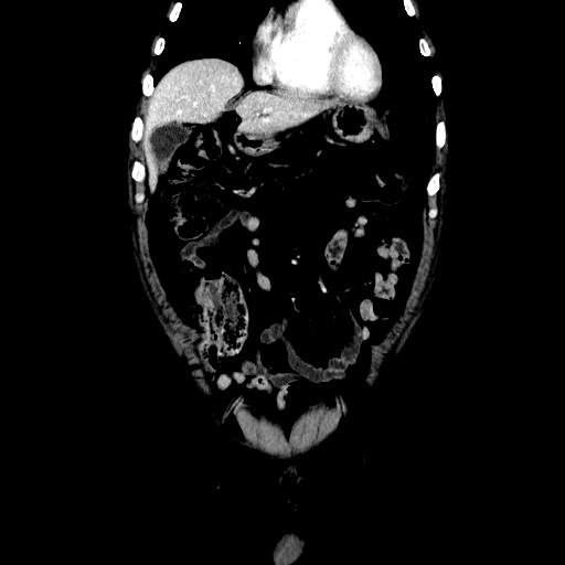 Choledocholiathiasis with normal caliber common bile duct (Radiopaedia 75368-86632 Coronal liver window 38).jpg