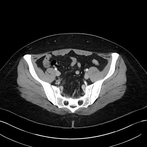 File:Choledocholithiasis after recent cholecystectomy (Radiopaedia 60929-68737 Axial 36).jpg