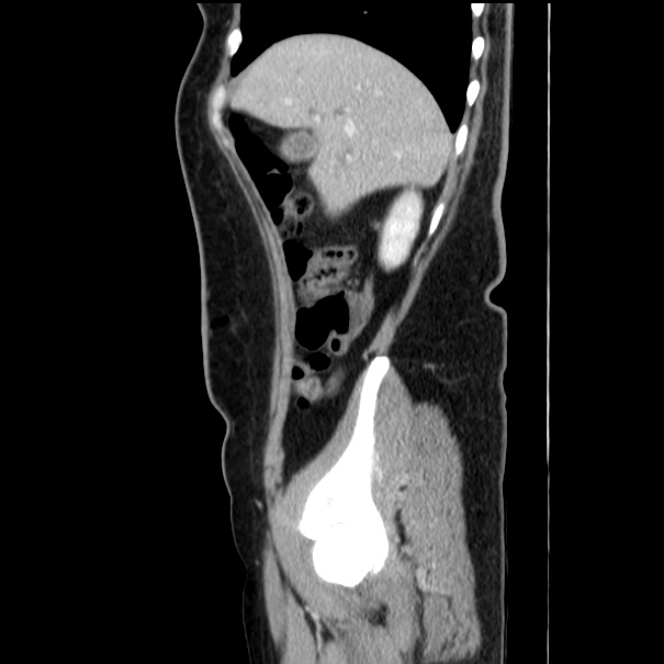 Choledocholithiasis on CT and MRI (Radiopaedia 24825-25087 D 16).jpg