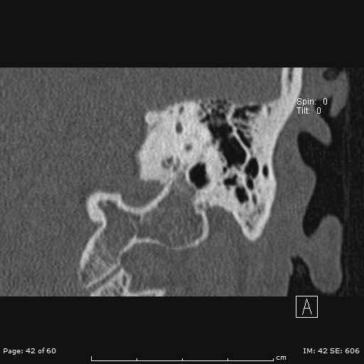 File:Cholesteatoma - external auditory canal (Radiopaedia 88452-105096 Coronal bone window 42).jpg