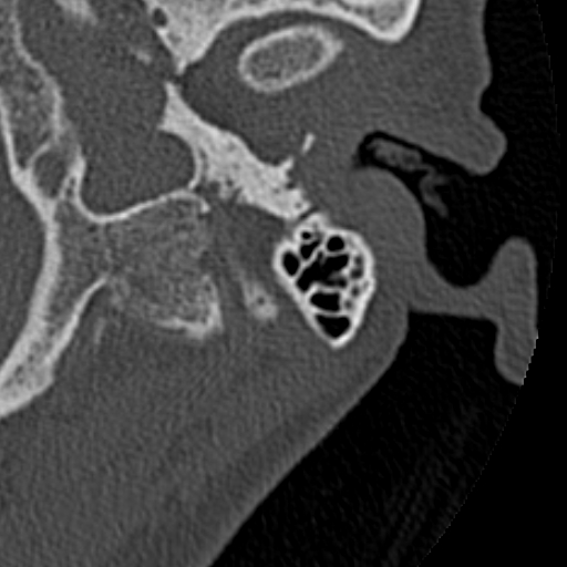 File:Cholesteatoma of the external ear (Radiopaedia 16540-16225 Axial bone window 33).jpg