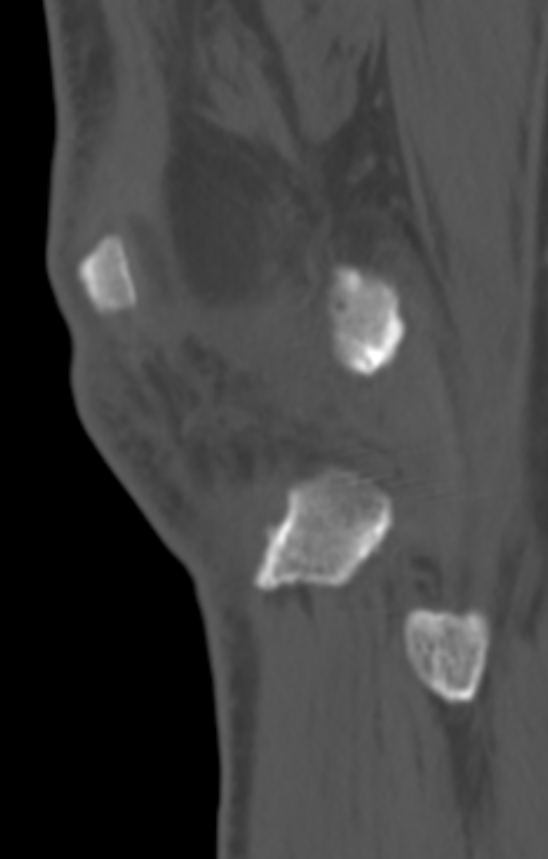 Chondrocalcinosis (Radiopaedia 82862-97173 Sagittal bone window 59).jpg