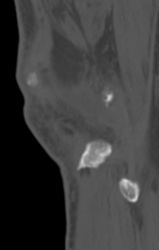 Chondrocalcinosis (Radiopaedia 82862-97173 Sagittal bone window 60).jpg
