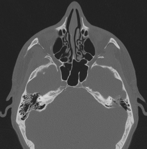 File:Chondrosarcoma (clivus) (Radiopaedia 46895-51425 Axial bone window 42).png