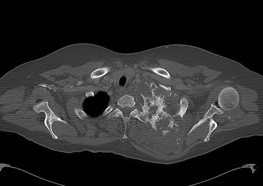 Chondrosarcoma - chest wall (Radiopaedia 65192-74199 Axial bone window 17).jpg