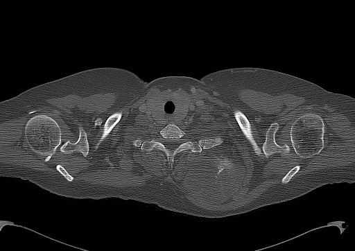 File:Chondrosarcoma - chest wall (Radiopaedia 65192-74199 Axial bone window 9).jpg