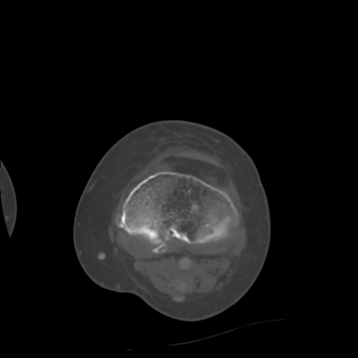 Chondrosarcoma - femur (Radiopaedia 64187-72954 Axial bone window 55).jpg