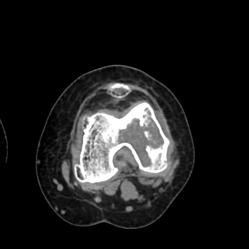 Chondrosarcoma - femur (Radiopaedia 64187-72954 Axial non-contrast 49).jpg