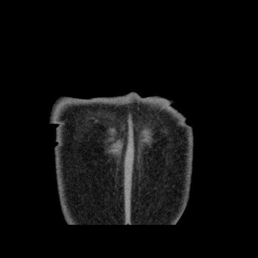 Chondrosarcoma of iliac wing (Radiopaedia 63861-72599 Coronal non-contrast 113).jpg