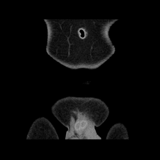File:Chondrosarcoma of iliac wing (Radiopaedia 63861-72599 Coronal non-contrast 15).jpg