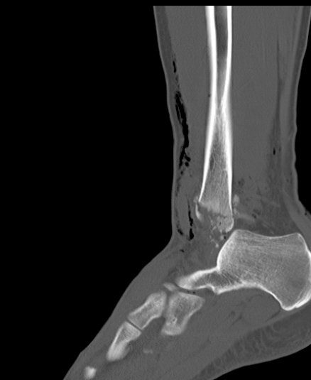 Chopart fracture (Radiopaedia 35347-36851 Sagittal bone window 43).jpg