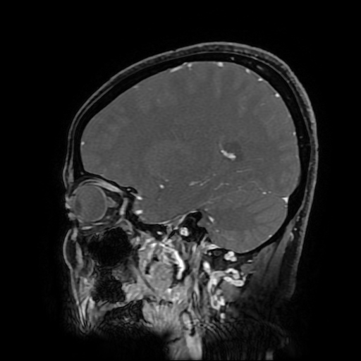 File:Chordoid glioma of third ventricle (Radiopaedia 91612-109340 F 139).jpg