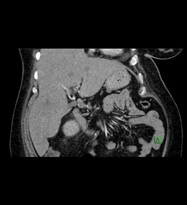 Chromophobe renal cell carcinoma (Radiopaedia 84239-99519 C 33).jpg