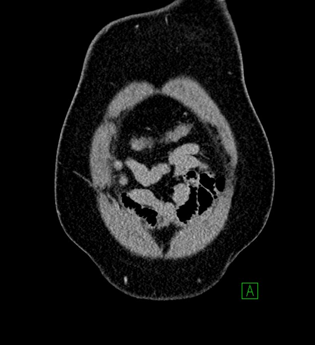 Chromophobe renal cell carcinoma (Radiopaedia 84286-99573 H 16).jpg