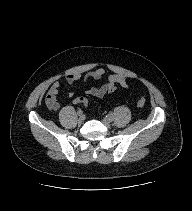 Chromophobe renal cell carcinoma (Radiopaedia 84337-99693 Axial non-contrast 114).jpg