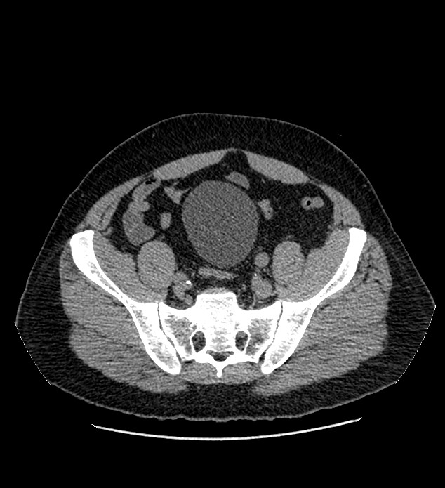 Chromophobe renal cell carcinoma (Radiopaedia 84337-99693 Axial non-contrast 123).jpg