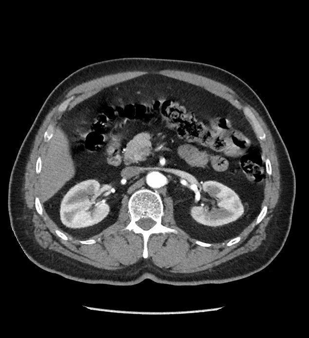 Chromophobe renal cell carcinoma (Radiopaedia 86879-103083 B 53).jpg
