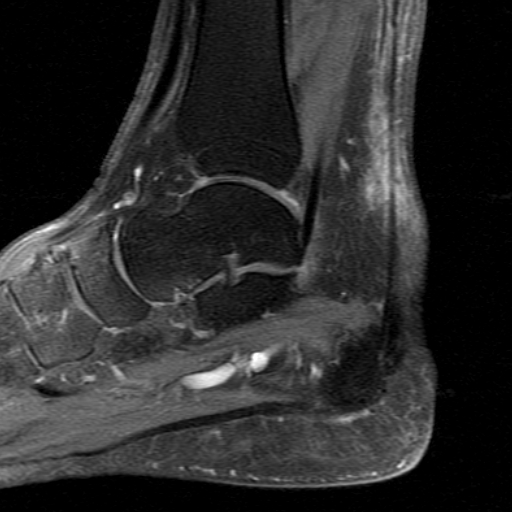 File:Chronic Achilles tendon rupture (Radiopaedia 15262-15100 C 9).jpg
