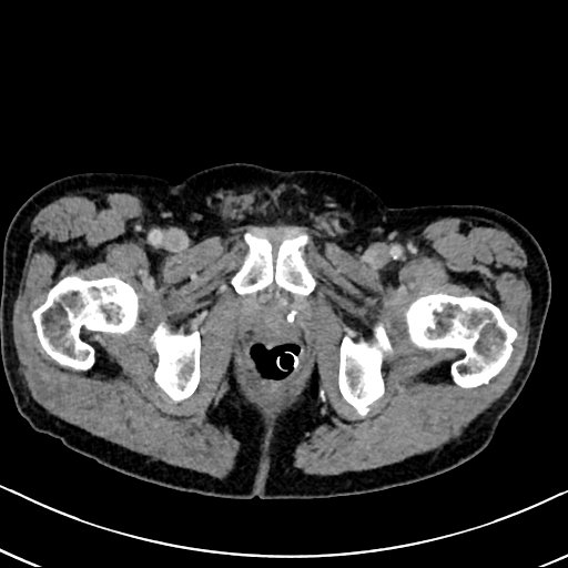 Chronic appendicitis complicated by appendicular abscess, pylephlebitis and liver abscess (Radiopaedia 54483-60700 B 148).jpg