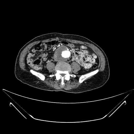 File:Chronic contained rupture of abdominal aortic aneurysm with extensive erosion of the vertebral bodies (Radiopaedia 55450-61901 A 41).jpg