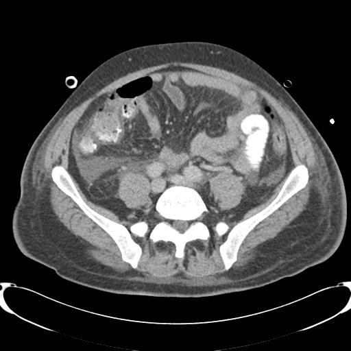 Chronic diverticulitis complicated by hepatic abscess and portal vein thrombosis (Radiopaedia 30301-30938 A 64).jpg