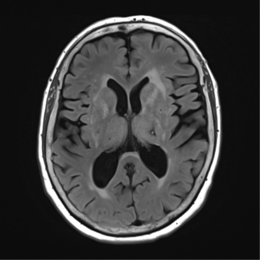 File:Chronic hypertensive encephalopathy (Radiopaedia 39993-42482 Axial FLAIR 15).png