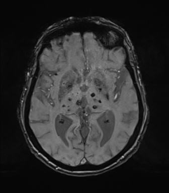 Chronic hypertensive encephalopathy (Radiopaedia 72844-83495 Axial SWI magnitude 41).png