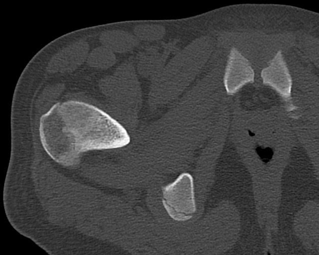 File:Chronic ostemyelitis of the femur with long sinus tract (Radiopaedia 74947-85982 Axial bone window 11).jpg