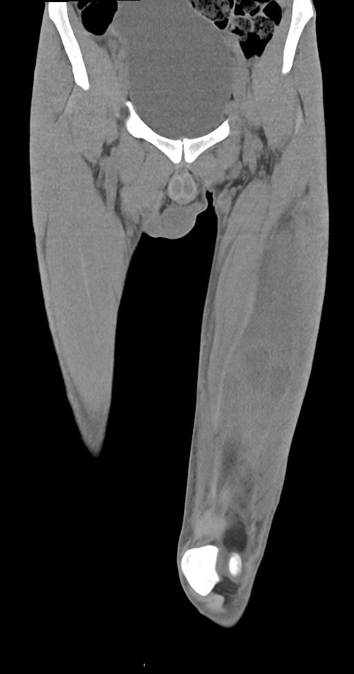 Chronic osteomyelitis (with sequestrum) (Radiopaedia 74813-85822 E 13).jpg