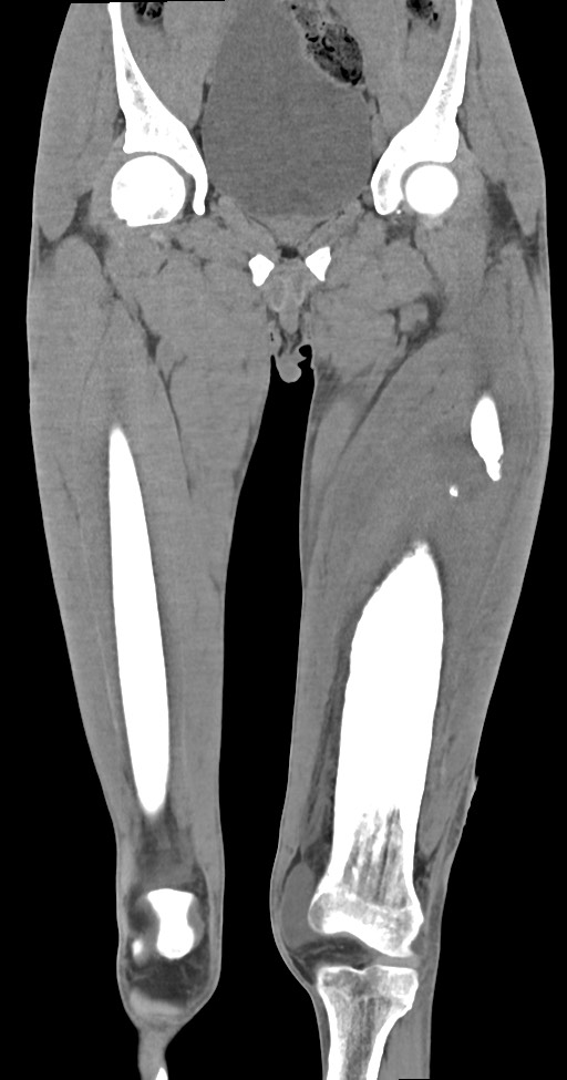 Chronic osteomyelitis (with sequestrum) (Radiopaedia 74813-85822 E 21).jpg