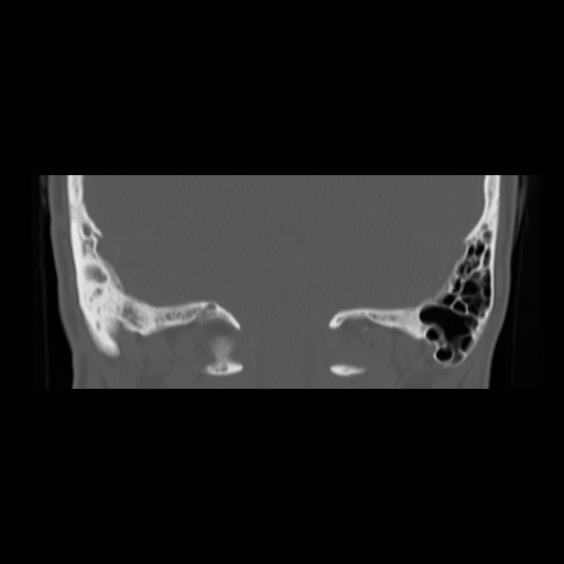 File:Chronic otomastoiditis (Radiopaedia 27138-27309 Coronal bone window 21).jpg