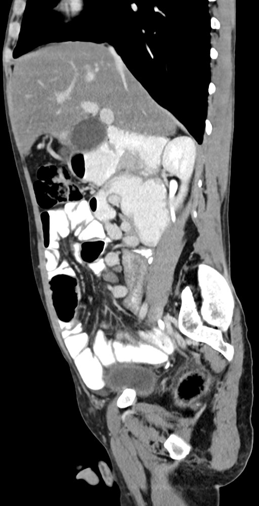 Chronic small bowel volvulus (Radiopaedia 75224-86322 C 93).jpg