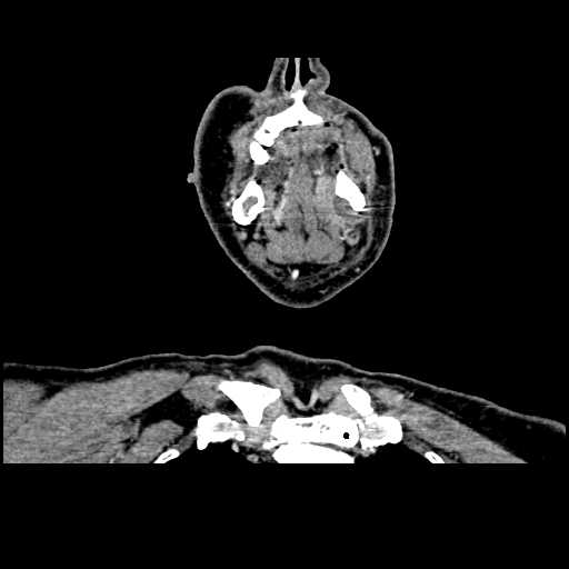 File:Chronic submandibular abscess (Radiopaedia 21738-21718 B 7).jpg