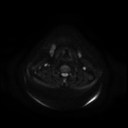 Chronic submandibular sialadenitis (Radiopaedia 61852-69885 Axial DWI 19).jpg
