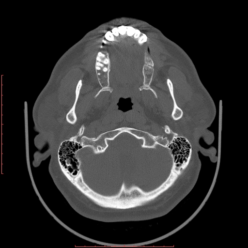 Chronic submandibular sialolithiasis (Radiopaedia 69817-79814 Axial bone window 4).jpg
