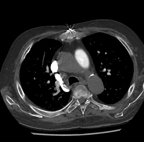 Chronic thromboembolic pulmonary disease (Radiopaedia 90694-108119 Axial C+ CTPA 35).jpg