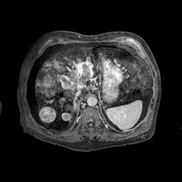 Cirrhosis and hepatocellular carcinoma in the setting of hemochromatosis (Radiopaedia 75394-86594 Axial T1 C+ fat sat 310).jpg