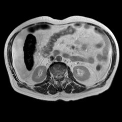 File:Cirrhosis and hepatocellular carcinoma in the setting of hemochromatosis (Radiopaedia 75394-86594 Axial T2 6).jpg
