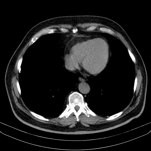 File:Classic complicated silicosis (Radiopaedia 49720-54961 Axial liver window 40).jpg