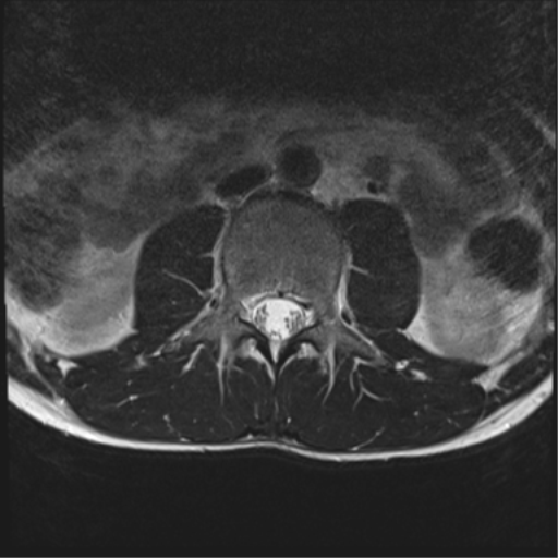 File:Clear cell meningoma - lumbar spine (Radiopaedia 60116-67690 Axial T2 29).png